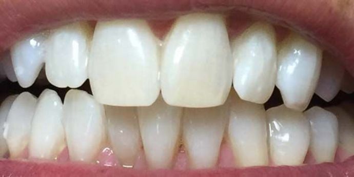after teeth whitening